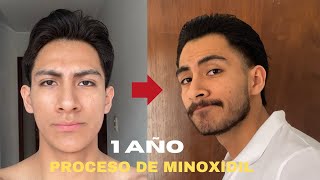 1 AÑO USANDO MINOXIDIL PARA CRECER BARBA SIENDO 100 LAMPIÑO [upl. by Elleniad]