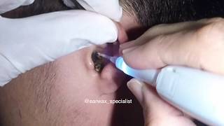 Mans MASSIVE Earwax Softened and Removed with Hydrogen Peroxide [upl. by Atilrahc]