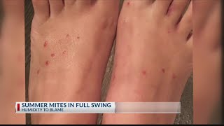 Chigger bite infestation in East Texas [upl. by Eiramrebma308]