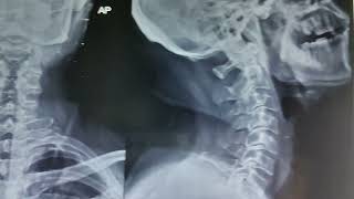 Cervical Spondylosis on Xray [upl. by Aryahay]