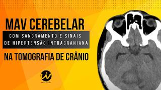 MALFORMAÇÃO ARTERIOVENOSA MAV CEREBELAR com Sangramento e Sinais de Hipertensão Intracraniana [upl. by Saravat]