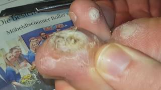 Plantar wart removing part 4 22  Dornwarze entfernen Teil 4 22 [upl. by Nawk880]