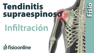 Tendinitis de hombro o supraespinoso infiltraciones [upl. by Trager]