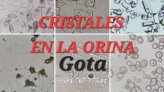 🔥 CRISTALES EN LA ORINA 🔥 Formación y Complicaciones [upl. by Aihsyt105]