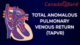 Total Anomalous Pulmonary Venous Return TAPVR [upl. by Ennayram]