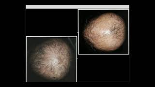 Dermoscopy of cicatricial alopecia 2 Dr Rania Al Akad [upl. by Inalel]