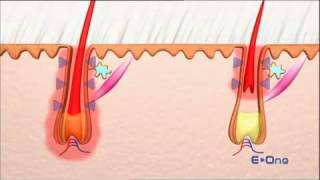 How works the épilation IPL intense light pulse [upl. by Estey]