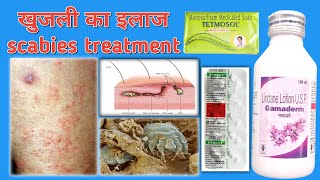 Gamaderm Lotion 🧴 Uses in Hindi खुजली का इलाज Scabies Treatment in Hindi [upl. by Ardiek354]