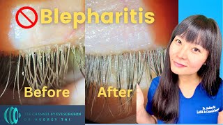 Best Blepharitis Treatments at Home  Simple amp Effective  Step by Step Guide Eye Surgeon Explains [upl. by Lottie]