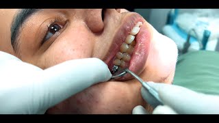 Mastering Orthodontics Treatments for Proclination Class II Malocclusion and Forward Placed Teeth [upl. by Iams120]