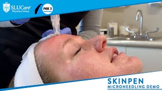 Skinpen Microneedling How it Works amp Demonstration  SLUCare MedSpa [upl. by Adim148]