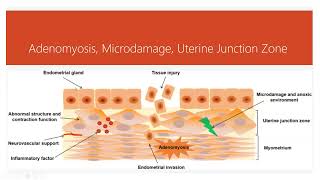 Natural Care for Adenomyosis [upl. by Gadmon557]