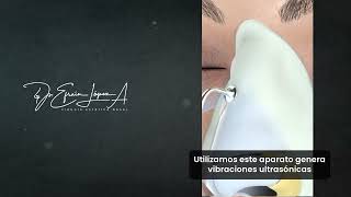 Rinoplastia Ultrasónica [upl. by Allebram]