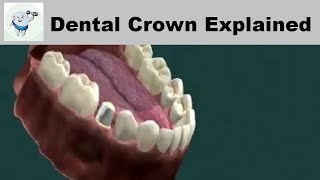 Types of Dental Crowns  Dental Crown Explained [upl. by Assetan]