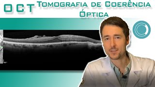 OCT  Tomografia de Coerência Óptica  Canal Retina e Vítreo [upl. by Devinne]