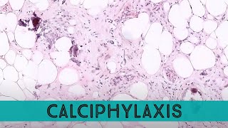 Calciphylaxis under the microscope complication of ESRD chronic kidney disease pathology dermpath [upl. by Netty675]