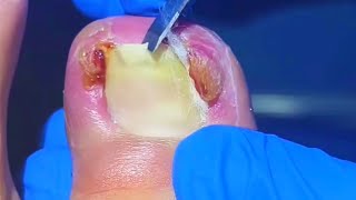 The Most EXTREME Ingrown Toenail Removal EVER [upl. by Orville]