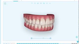 Simulación tratamiento Invisalign con escáner iTero 3D [upl. by Esinek]