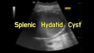 Splenic Hydatid Cyst [upl. by Auguste]