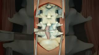 Lumbar Discectomy  3D Animation 4k animation asmr [upl. by Carrissa]