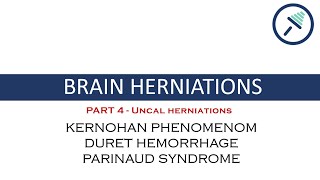 BRAIN HERNIATIONS 44 Uncal herniationDuret Hemorrhage Kernohan Phenomenom amp Parinaud Syndrome [upl. by Amitarp]