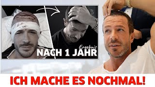 Meine Haartransplantation  Ich mache es noch einmal [upl. by Lias]