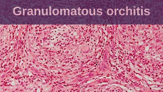 Idiopathic Granulomatous Orchitis  Pathology mini tutorial [upl. by Hettie3]