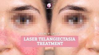 Skin Place Laser Telangiectasia Treatment [upl. by Darren845]