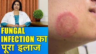 फंगल इन्फेक्शन का पूरा इलाज  Complete Treatment of Fungal Infections [upl. by Dimphia924]