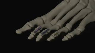 TwoStep Hammertoe Implant System Animation [upl. by Anawed]