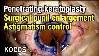 Penetrating keratoplasty surgical pupil enlargement astigmatism control [upl. by Arriat]