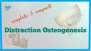 DISTRACTION OSTEOGENESIS [upl. by Tat]