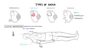 Approach to Shock  types hypovolemic cardiogenic distributive anaphylaxis pathology treatment [upl. by Peppel420]