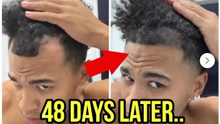 He REVERSED Hair Loss in 48 Days DOING THIS [upl. by Hock]