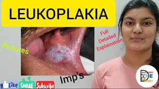 LEUKOPLAKIA  PREMALIGNANT LESION [upl. by Rizzo38]