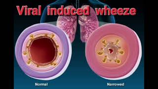 Viral induced wheeze History Management mrcpch Clinical [upl. by Moth974]