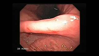 Video clip of an Upper Endoscopy [upl. by Atsocal]