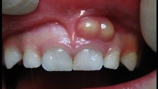 COMO TIRAR DOR DE DENTE  ABSCESSO DENTÁRIO  Drenagem [upl. by Ydualc704]