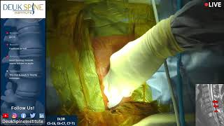 Watch Live Spine Surgery Deuk Laser Disc Repair C5C6 C6C7 C7T1 [upl. by Atirehs592]