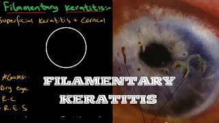 Filamentary Keratitis  Ophthalmology [upl. by Latrell]