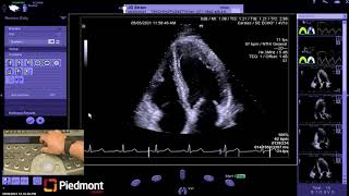 Piedmont Healthcare Left Ventricle Myocardial Strain Workflow on Siemens SC2000 [upl. by Ramar908]