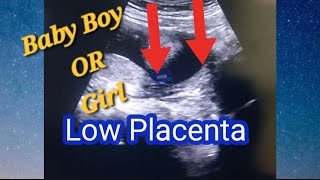 LOW Lying Placenta and Baby Gender ☺️  Posterior Placenta means Baby Girl or Boy  Genderreeal Scan [upl. by Ailelc576]