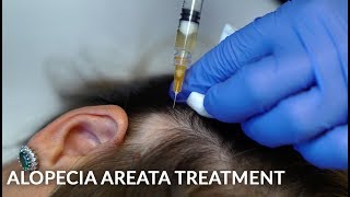 PRP Stem Cells amp Steroid Injections for Alopecia Areata Female Hair Loss Treatment  Dr Jason Emer [upl. by Ynahpit611]