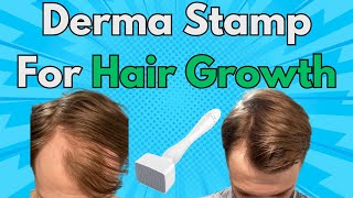 This Is Why You Should Add A Derma Stamp To Your Hair Growth Routine  Derma Stamp x Minoxidil Combo [upl. by Norek]