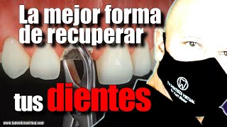 LOS IMPLANTES DENTALES CAMBIARON ¿LO SABÍAS [upl. by Nivan470]