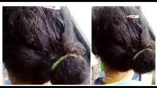 Woman On A Public Bus With A Bad Case Of Head Lice [upl. by Jeconiah687]