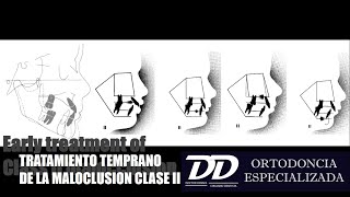 TRATAMIENTO TEMPRANO DE LA MALOCLUSION CLASE II [upl. by Irv426]