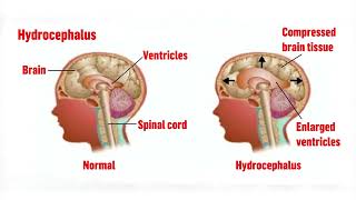 MENINGITIS BRAIN FEVER [upl. by Eednil]