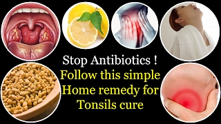 Natural treatment of Tonsils  How to cure tonsillitis without antibiotics  cure tonsils in 4 hours [upl. by Tamis]