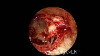 Endoscopic tympanosclerosis and atresia EAC surgery [upl. by Phipps]